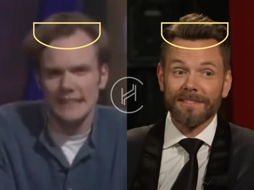 joel mchale - hair transplant before after result