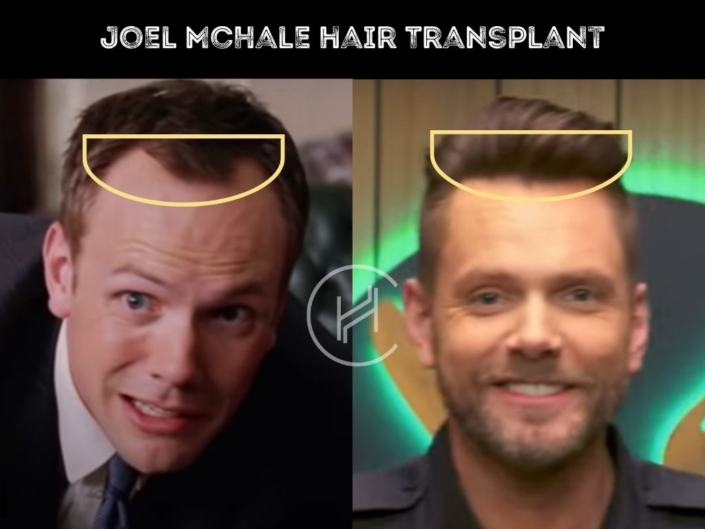joel mchale - hair transplant before after