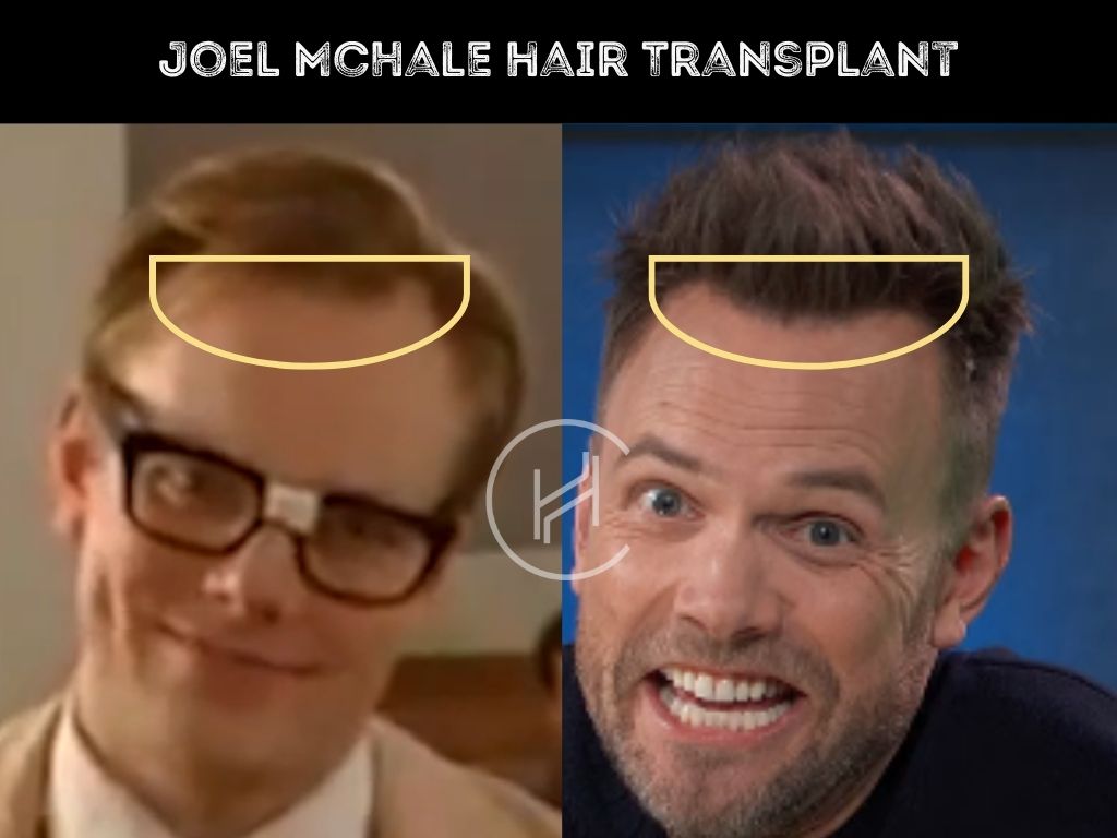 hair transplant before and after - joel mchale