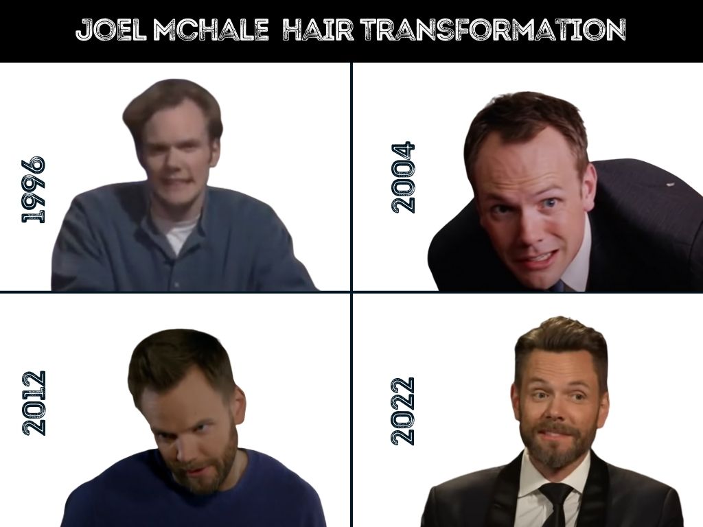 joel mchale hair loss and transformation after hair transplant