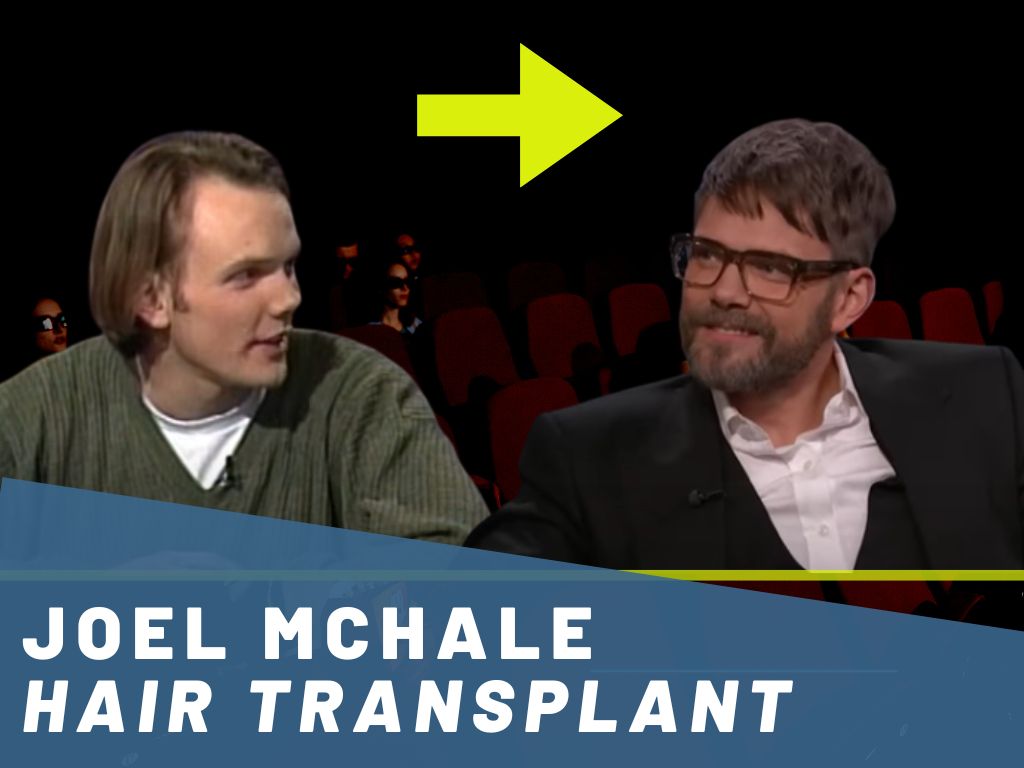 joel mchale hair transplant analysis banner