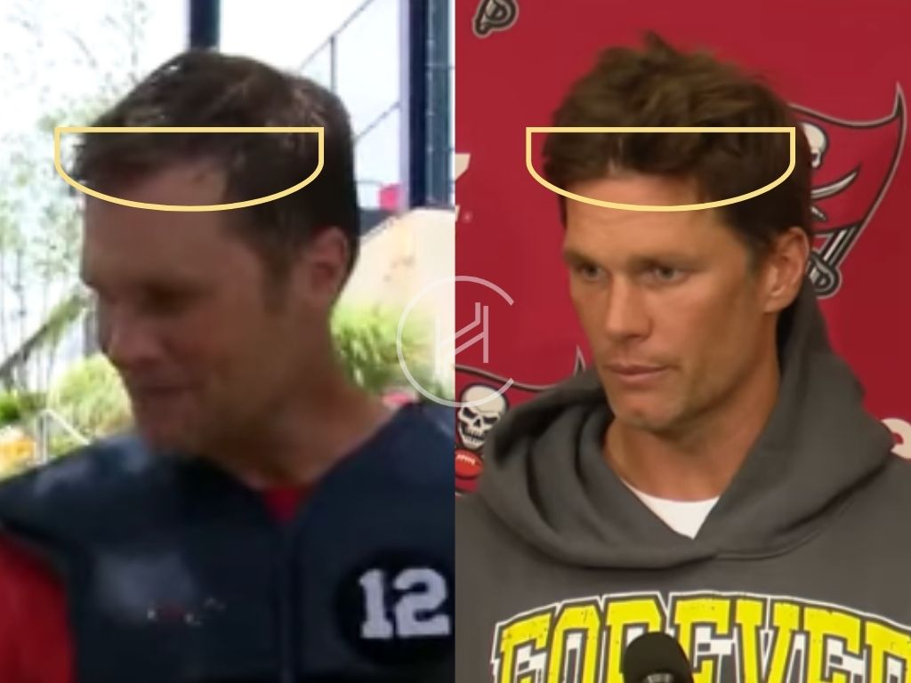 tom brady hair transplant before after hairline result