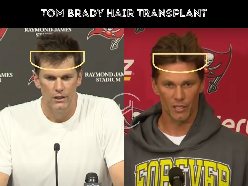 tom brady hair transplant before & after