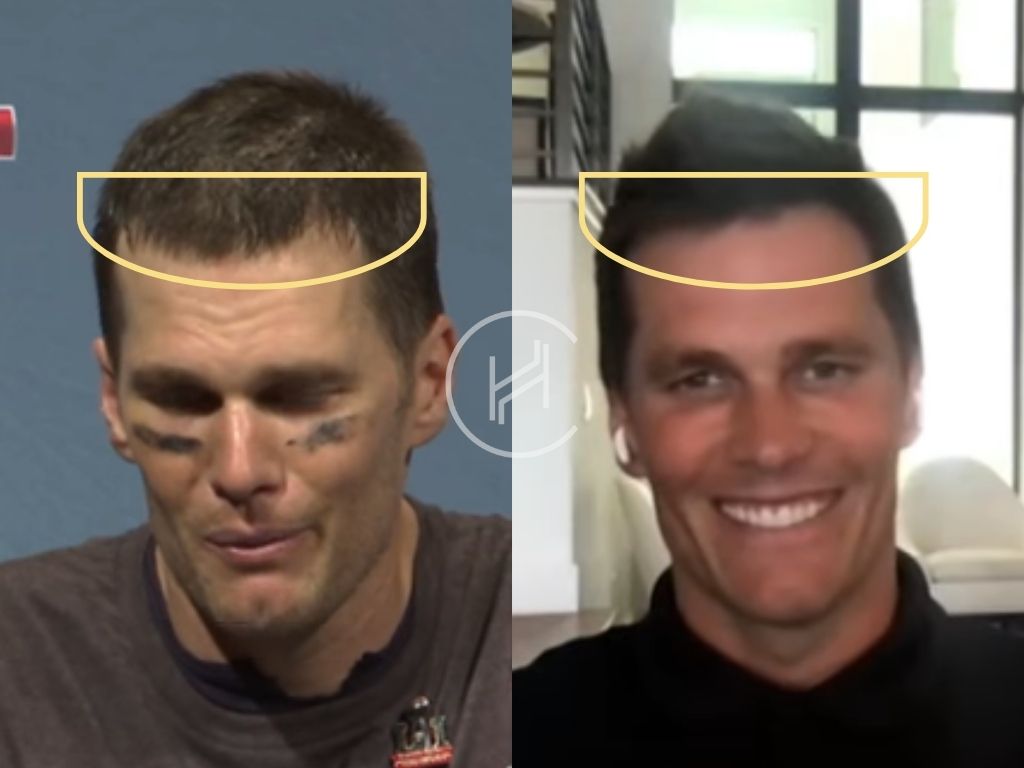 tom-brady-hair-transplant-before-and-after-result