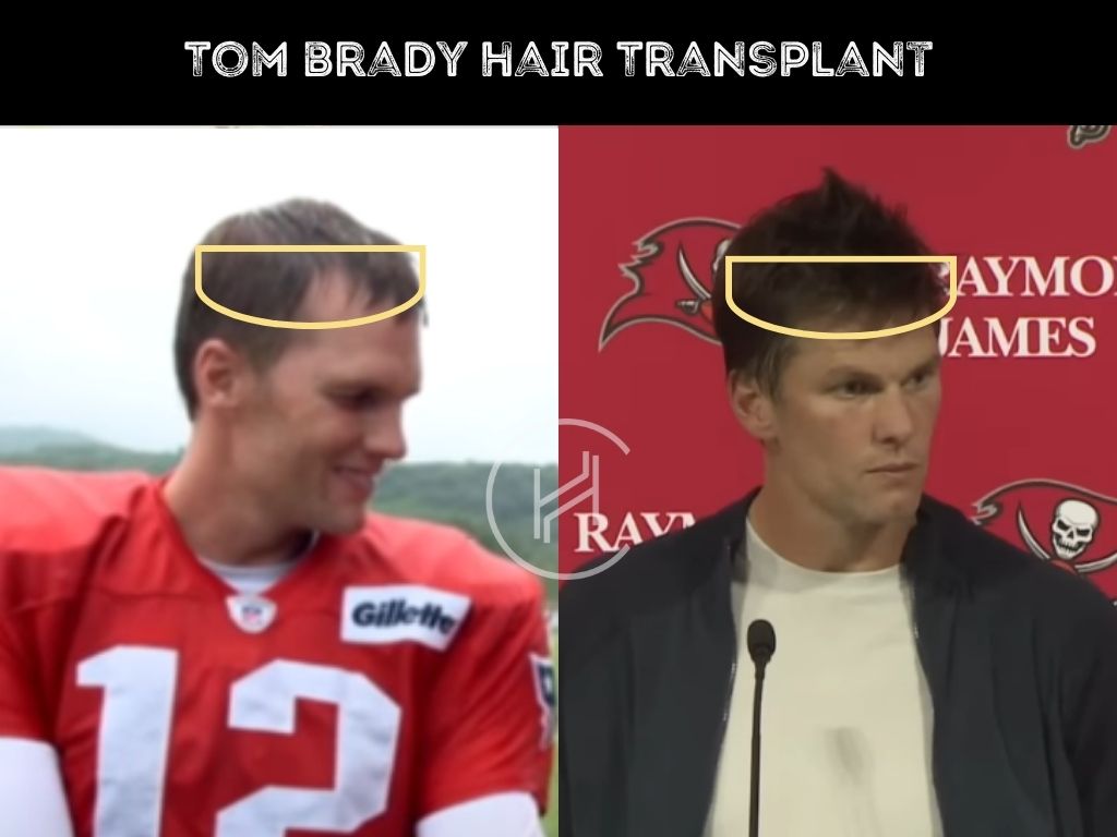 tom brady - hair transplant before and after