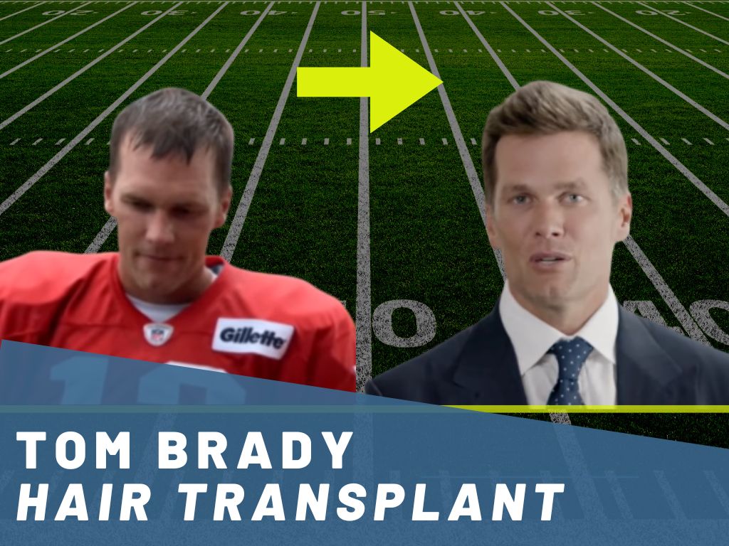 tom brady hair transplant analysis banner