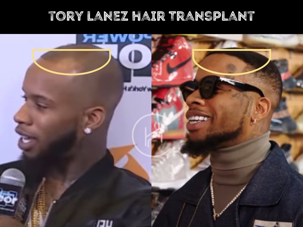 tory lanez hair transplant before after comparison