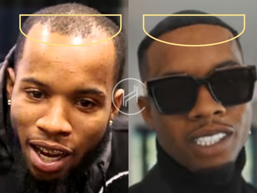 tory lanez hair transplant before and after result