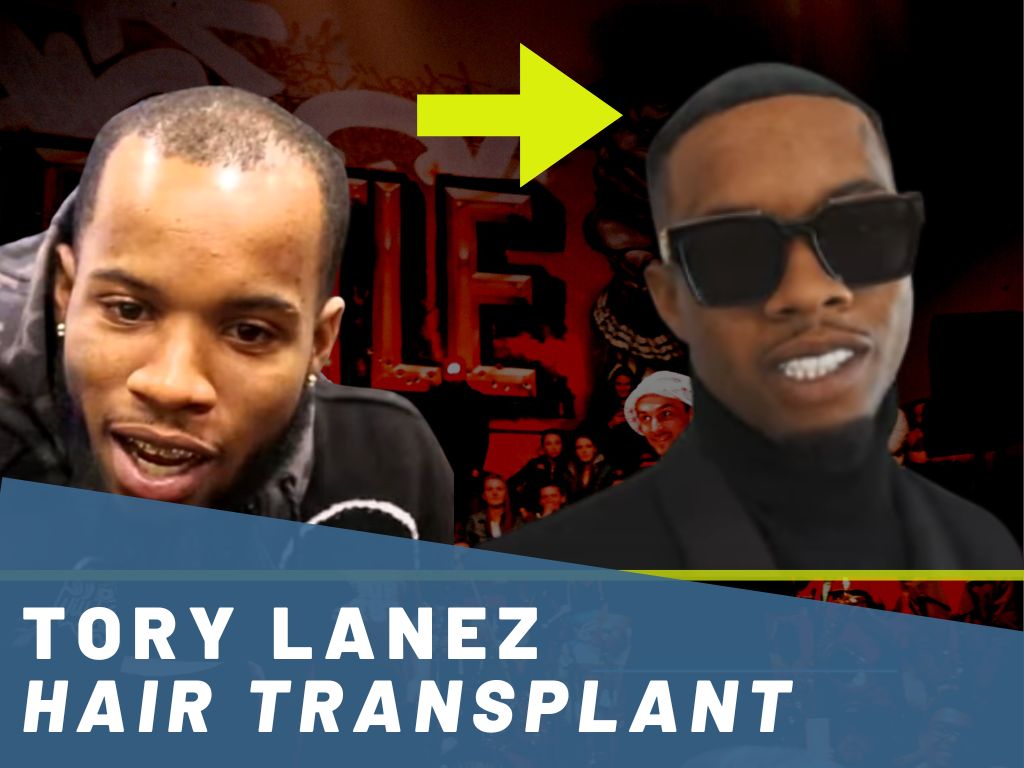 tory lanez hair transplant analysis banner