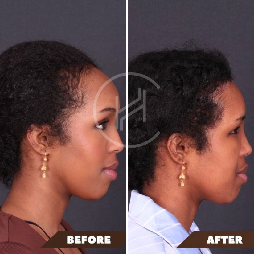 wide forehead reduction before & after result afro female (2)