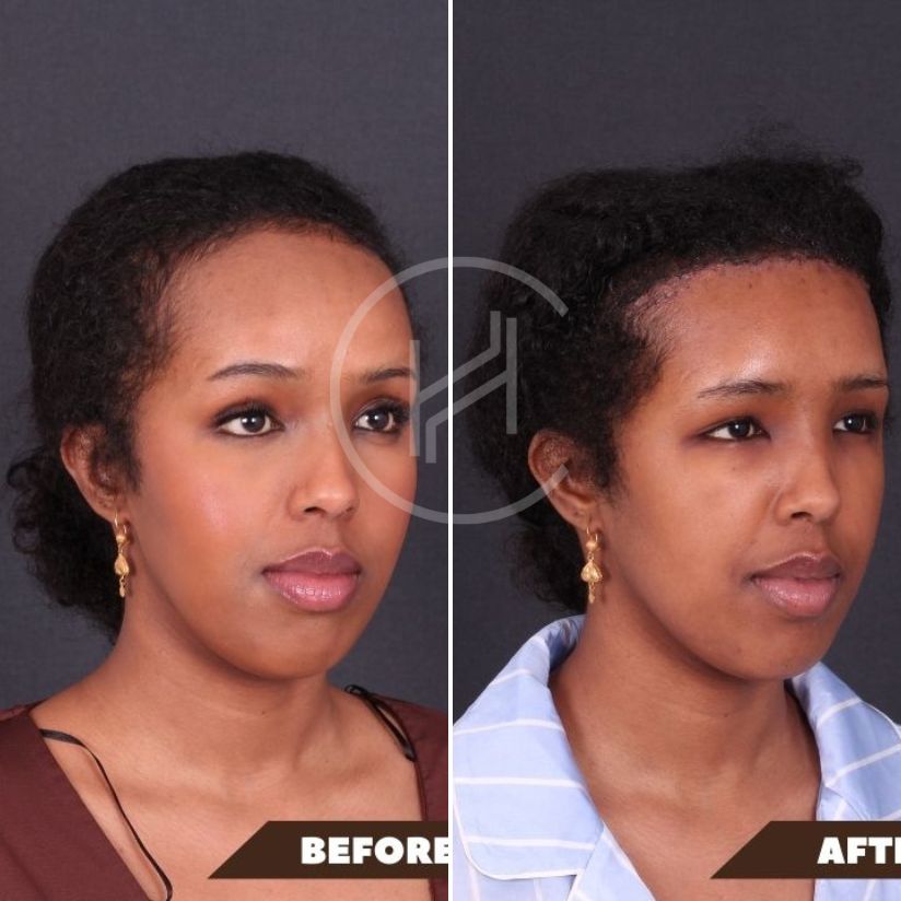 wide forehead reduction before & after result afro female