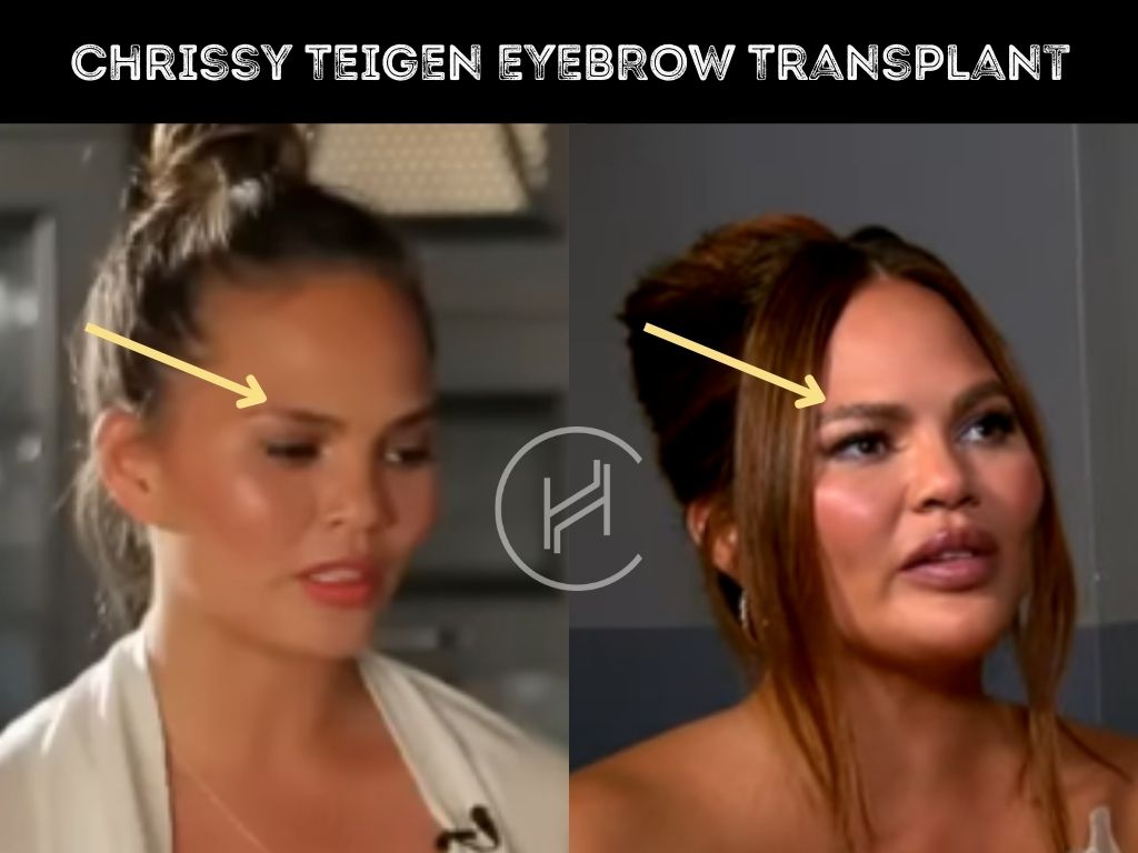 Chrissy Teigen - Eyebrow Transplant Surgery before and after