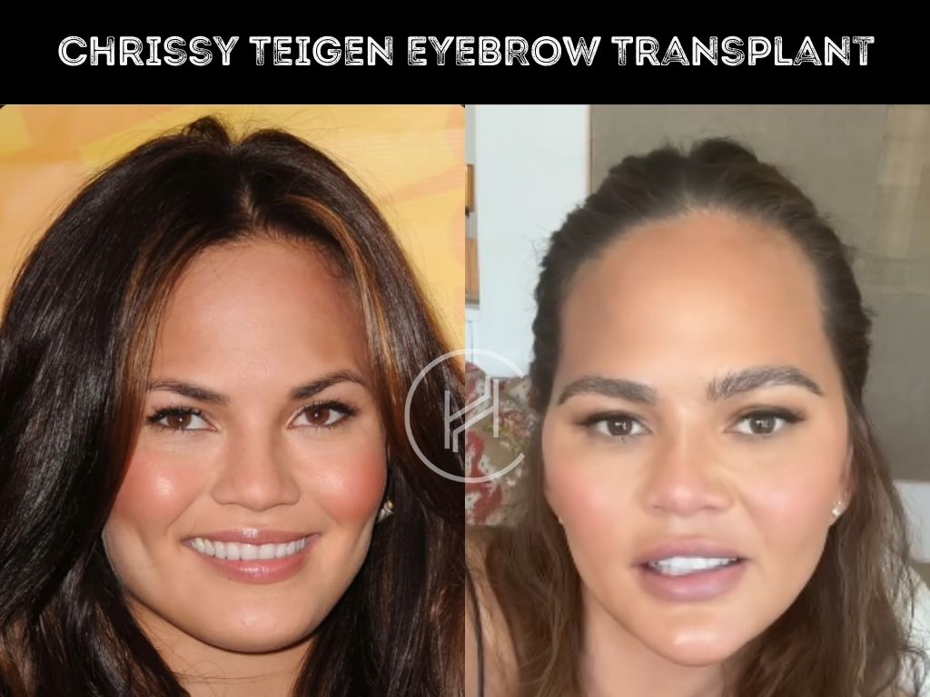 Chrissy Teigen - Eyebrow Transplant before after photo