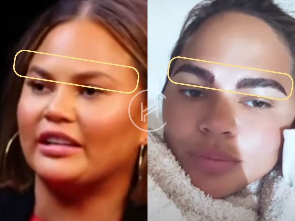 Chrissy Teigen - Eyebrow Transplant before and after result