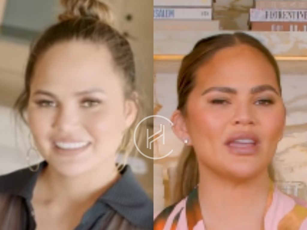 Eyebrow Transplant Before & After Chrissy Teigen