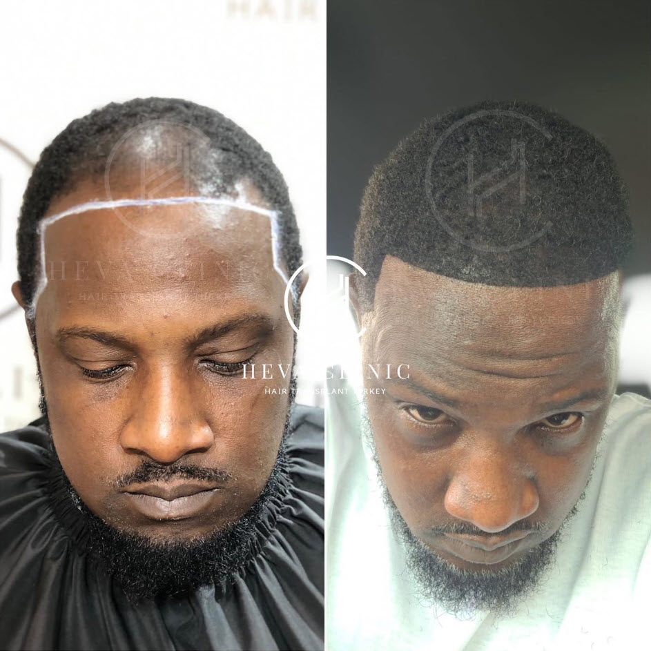 afro hair transplant hairline before and after