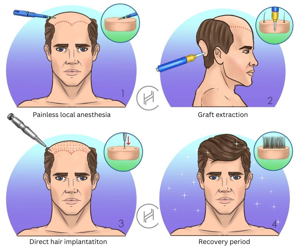 dhi-hair-transplant-process
