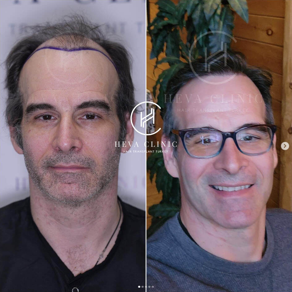 Norwood 6 hair transplant result 5000 grafts