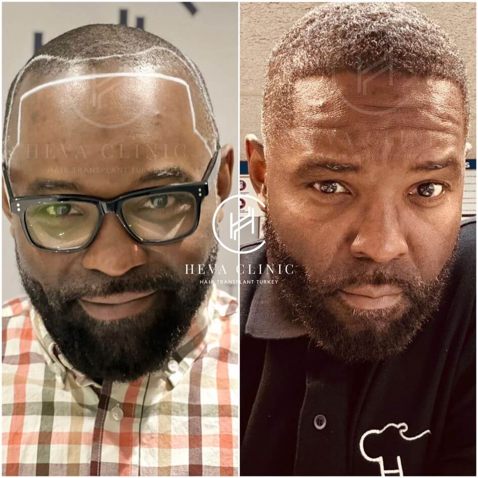 afro hair transplant before and after 2500 Grafts Norwood 2