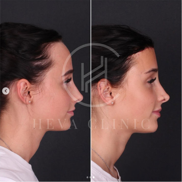 forehead reduction 3cm lowering hairline female patient - side angle