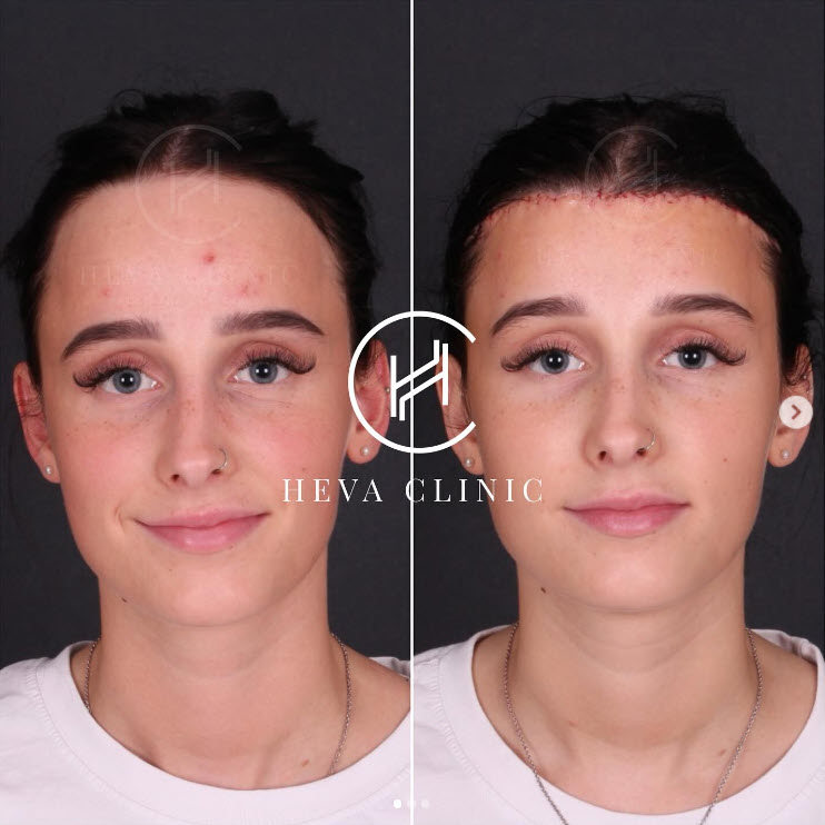 forehead reduction 3cm lowering hairline female patient