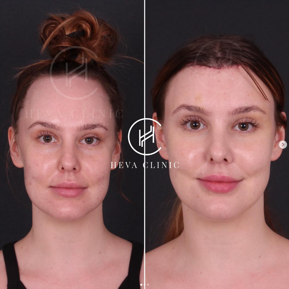 forehead reduction surgery before and after result 1
