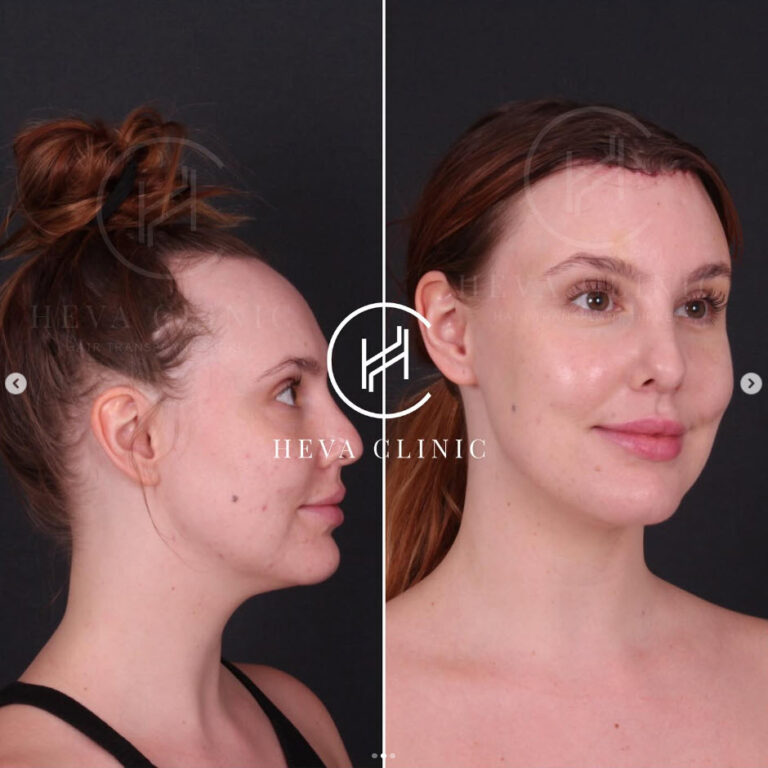 Forehead Reduction Before & After Photos Unfiltered Results