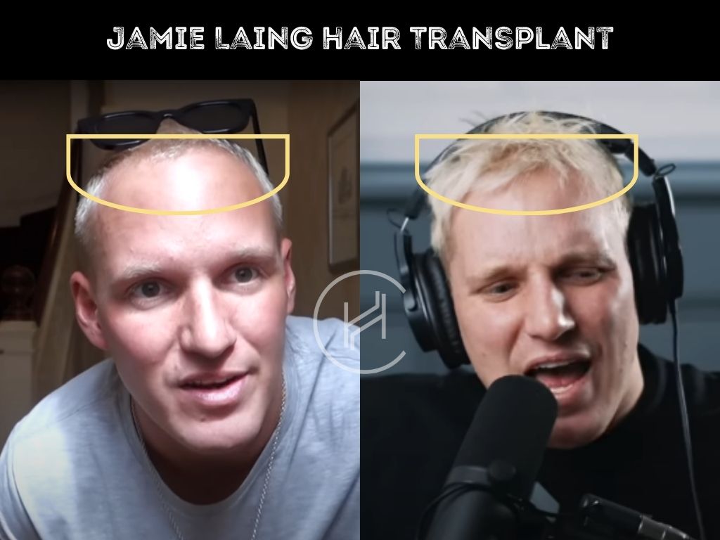 jamie laing - hair transplant before after result