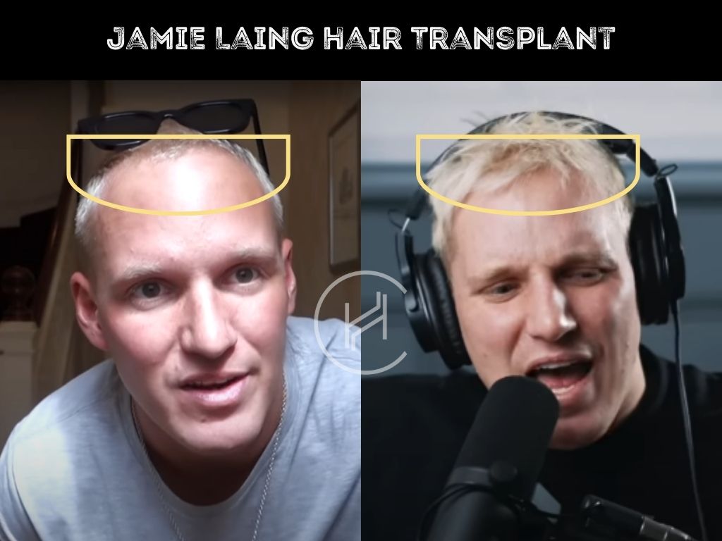 jamie laing hair transplant before & after result