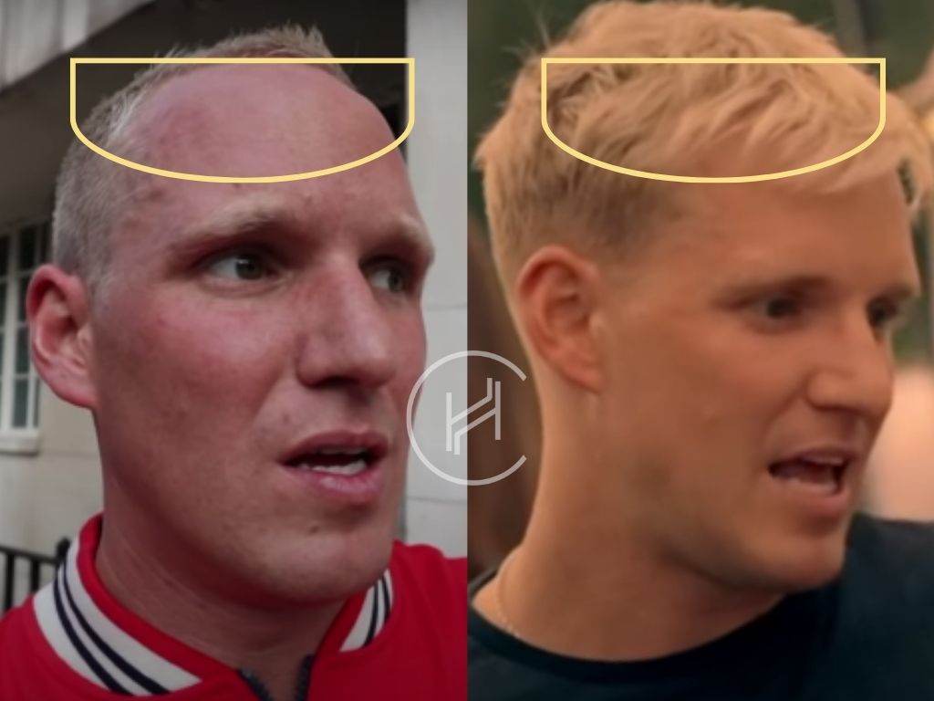 jamie laing hair transplant before after