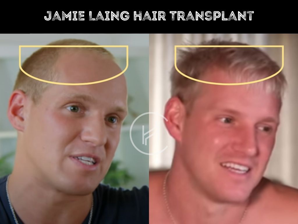 jamie laing hair transplant before and after result