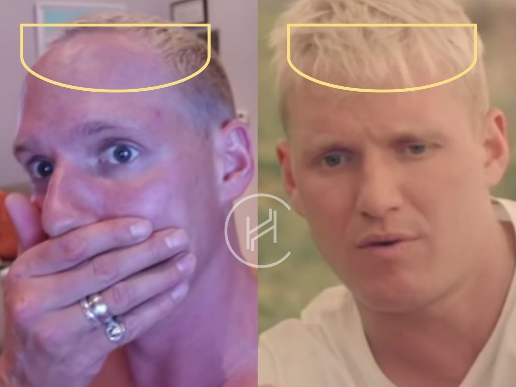 jamie laing hair transplant before and after