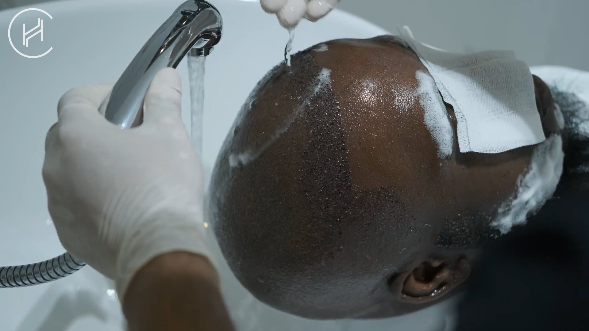 washing hair after hair transplant for the first time