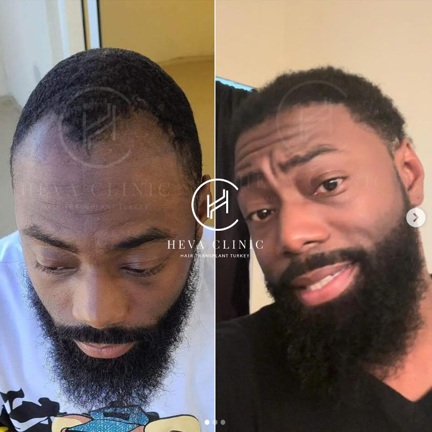 3000 grafts 7 months afro hair transplant before & after result