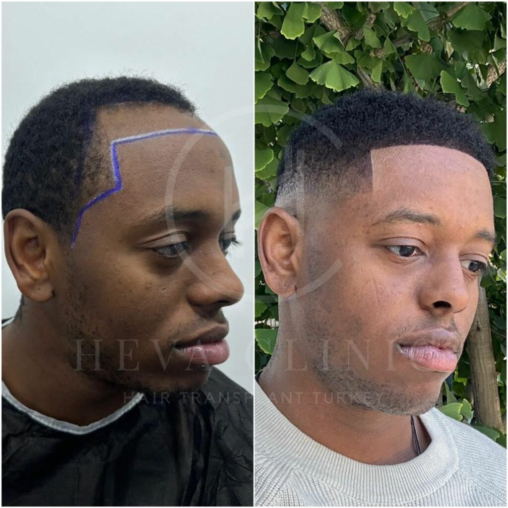 Afro hairline restoration - hair transplant before and after - side