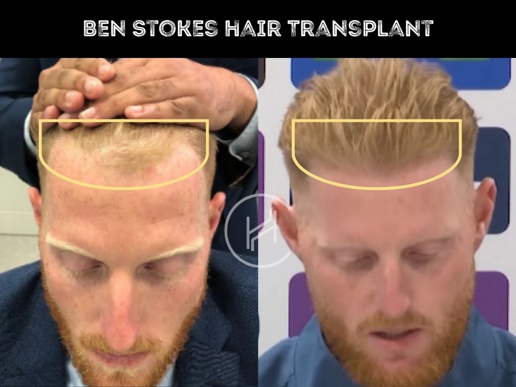 ben stokes hair transplant before and after
