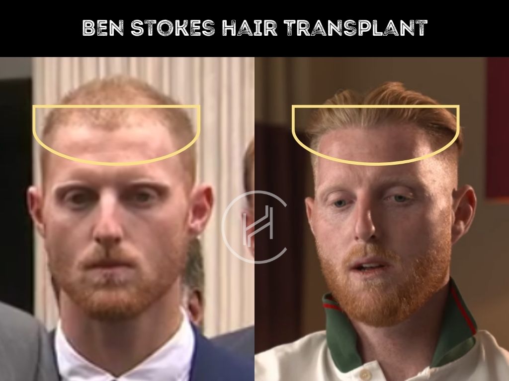 ben stokes hair transplant before after result