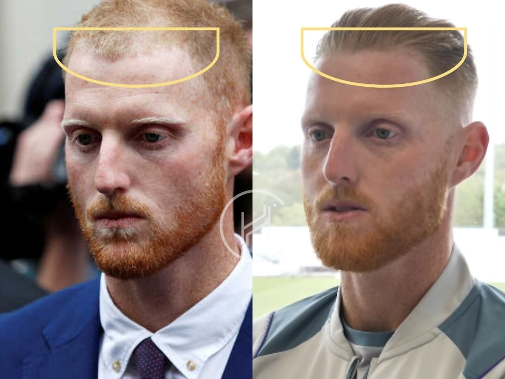 ben stokes hair transplant before and after result