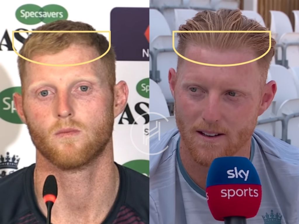 ben stokes hair transplant before and after