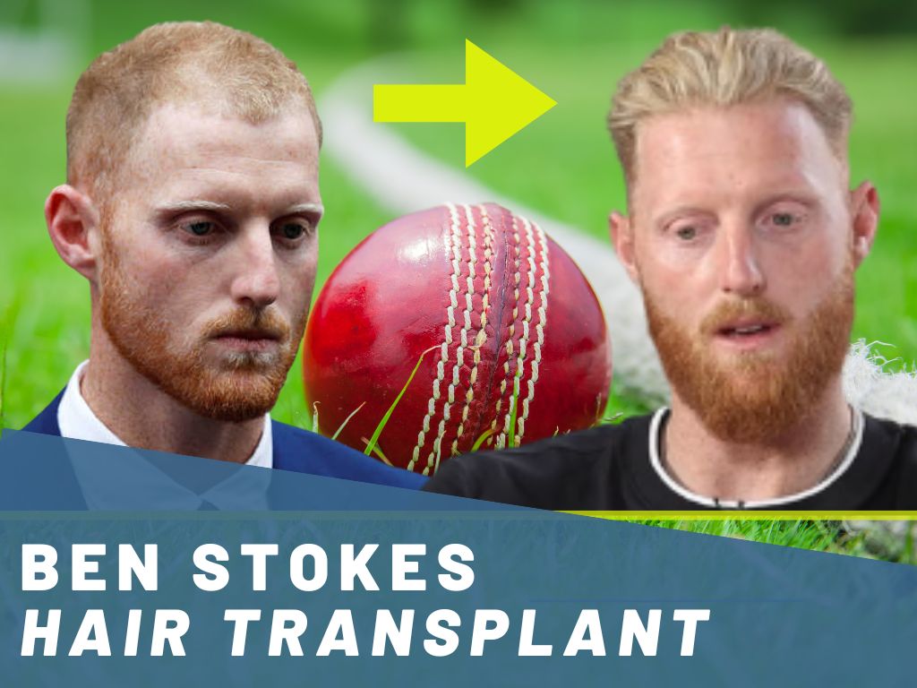 ben stokes hair transplant analysis banner