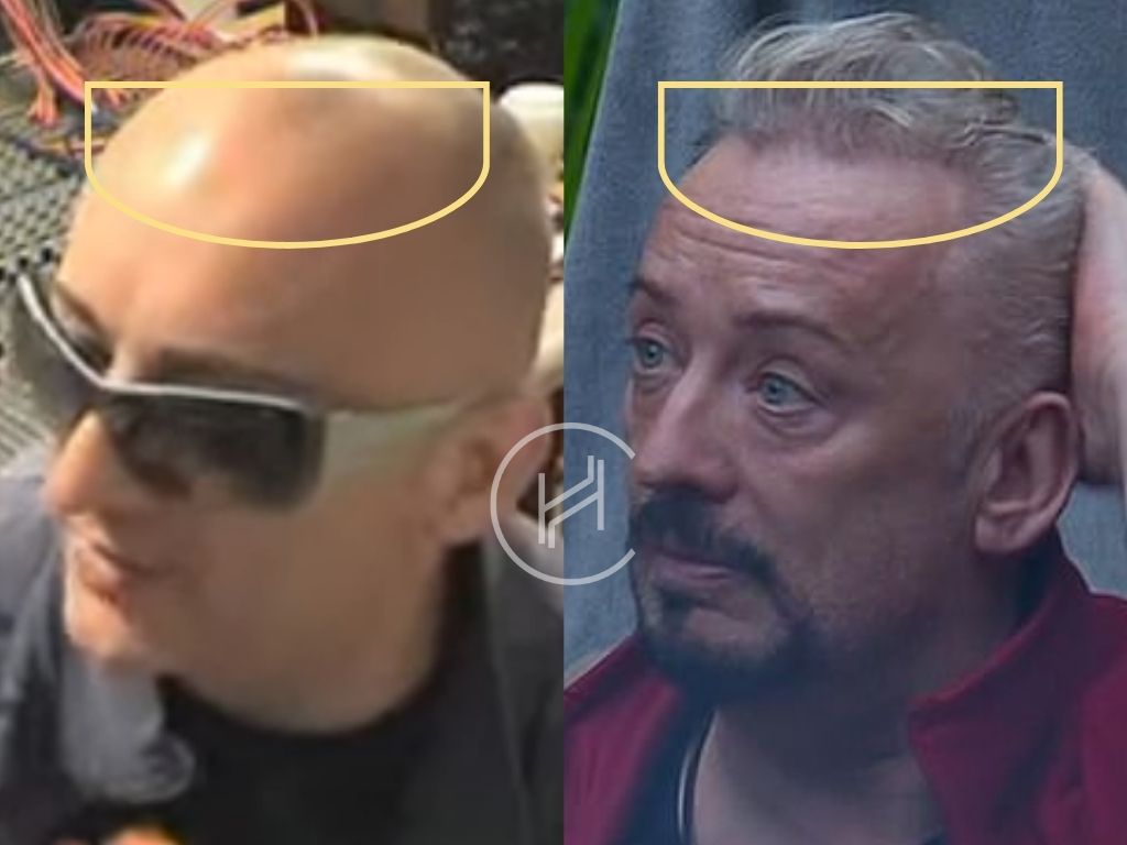 boy george hair transplant before and after result