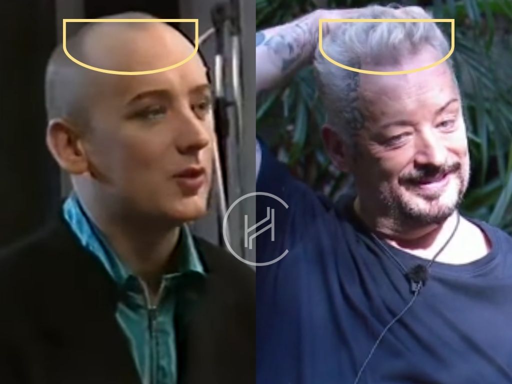 boy george hair transplant before after hair density