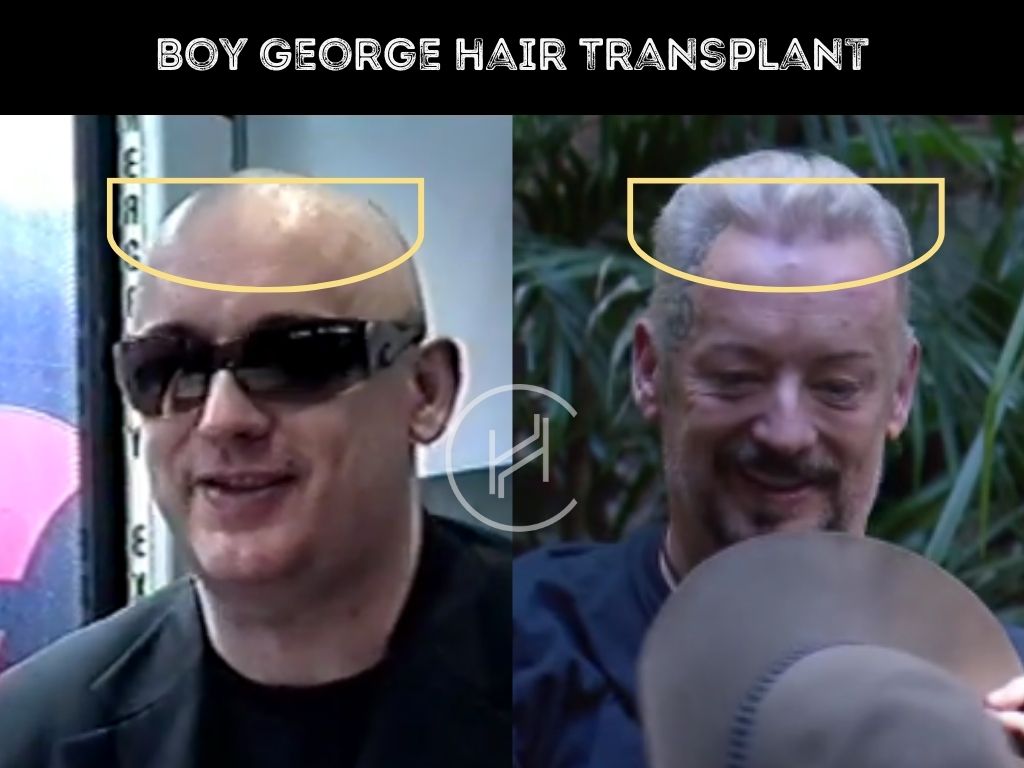 boy george hair transplant before and after result