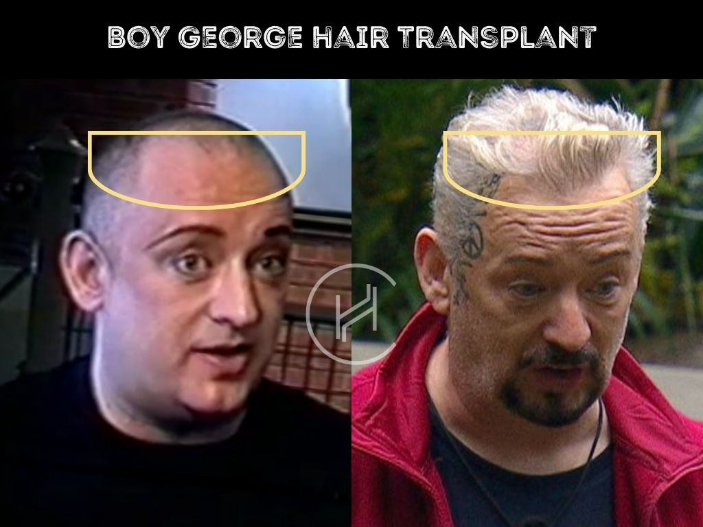 boy george hair transplant before and after