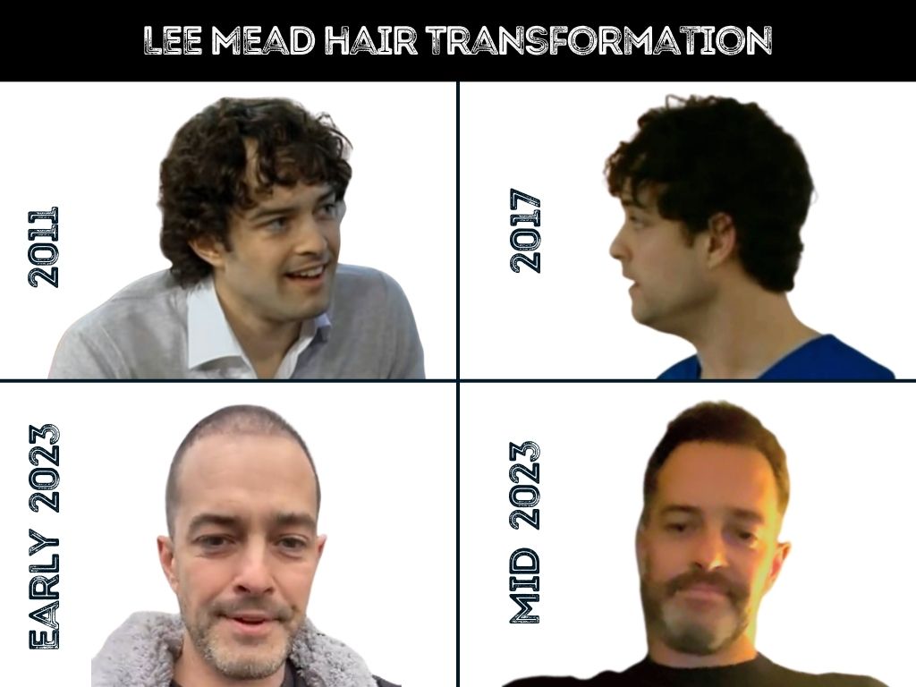 lee mead hair transformation after hair transplant