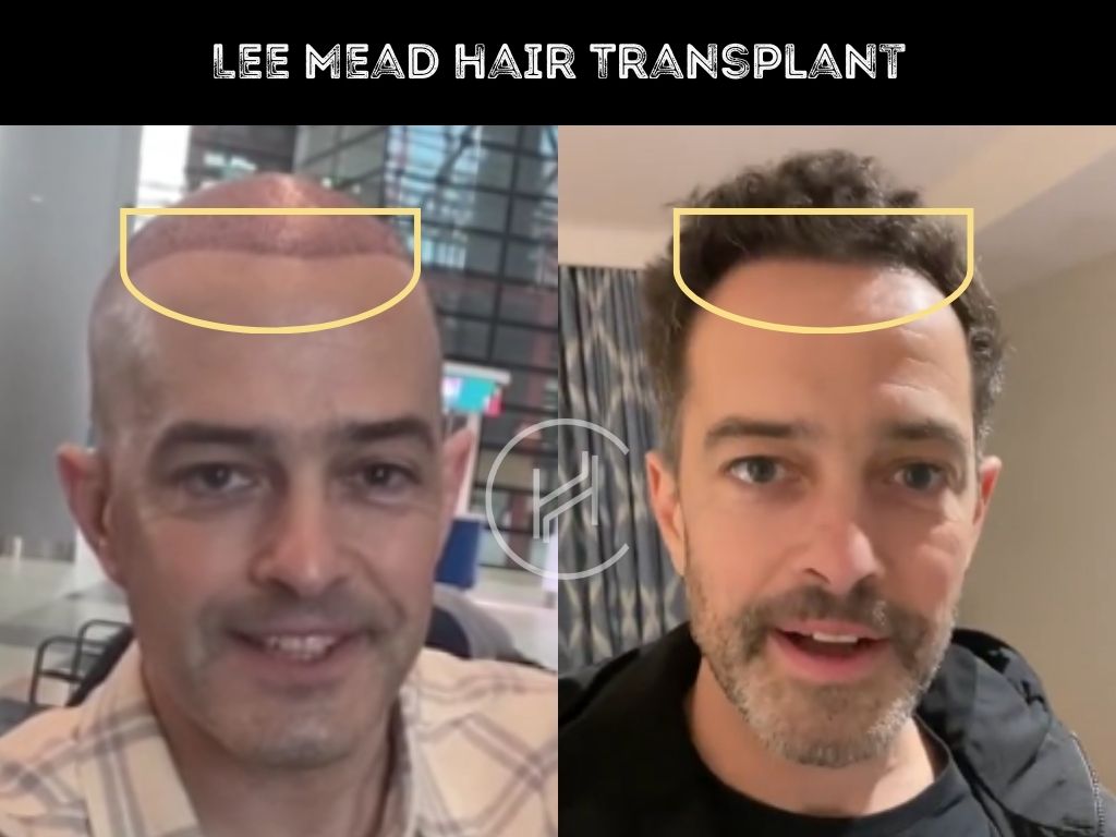 Lee Mead hair transplant before after result