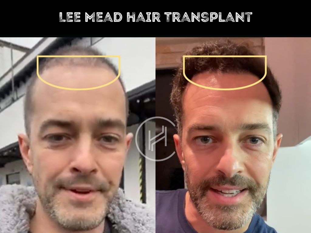 lee mead hair transplant before & after
