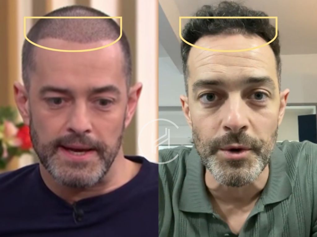 lee mead hair transplant before and after result