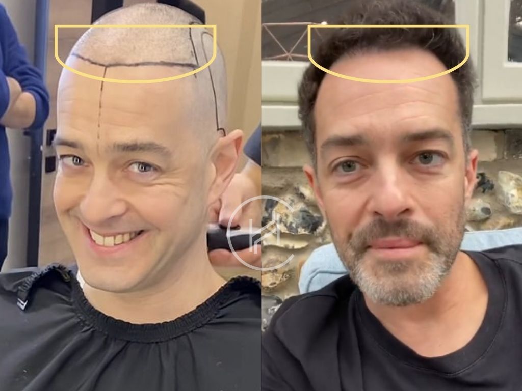 hair transplant before and after - lee mead