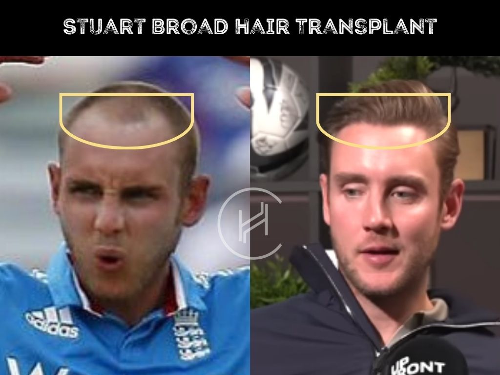 stuart broad hair transplant before after result